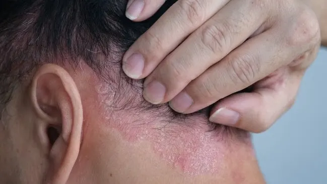 Kulit Kepala Gatal dan Terkelupas