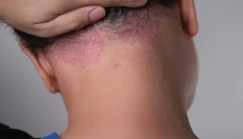 ketombe-psoriasis