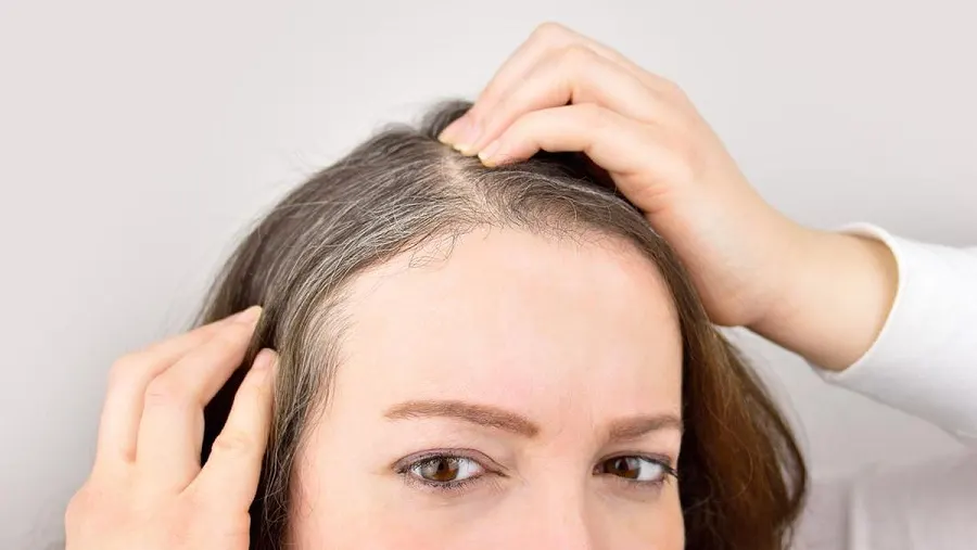 Rahasia Kesehatan Rambut: Mengapa Produksi Melanin Bisa Menurun Lebih Cepat?